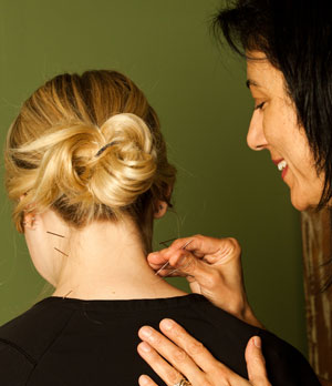 Acupuncture Treatment Acupuncture Treatment